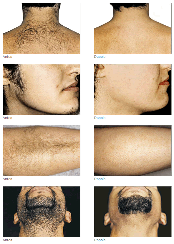 antes-depois